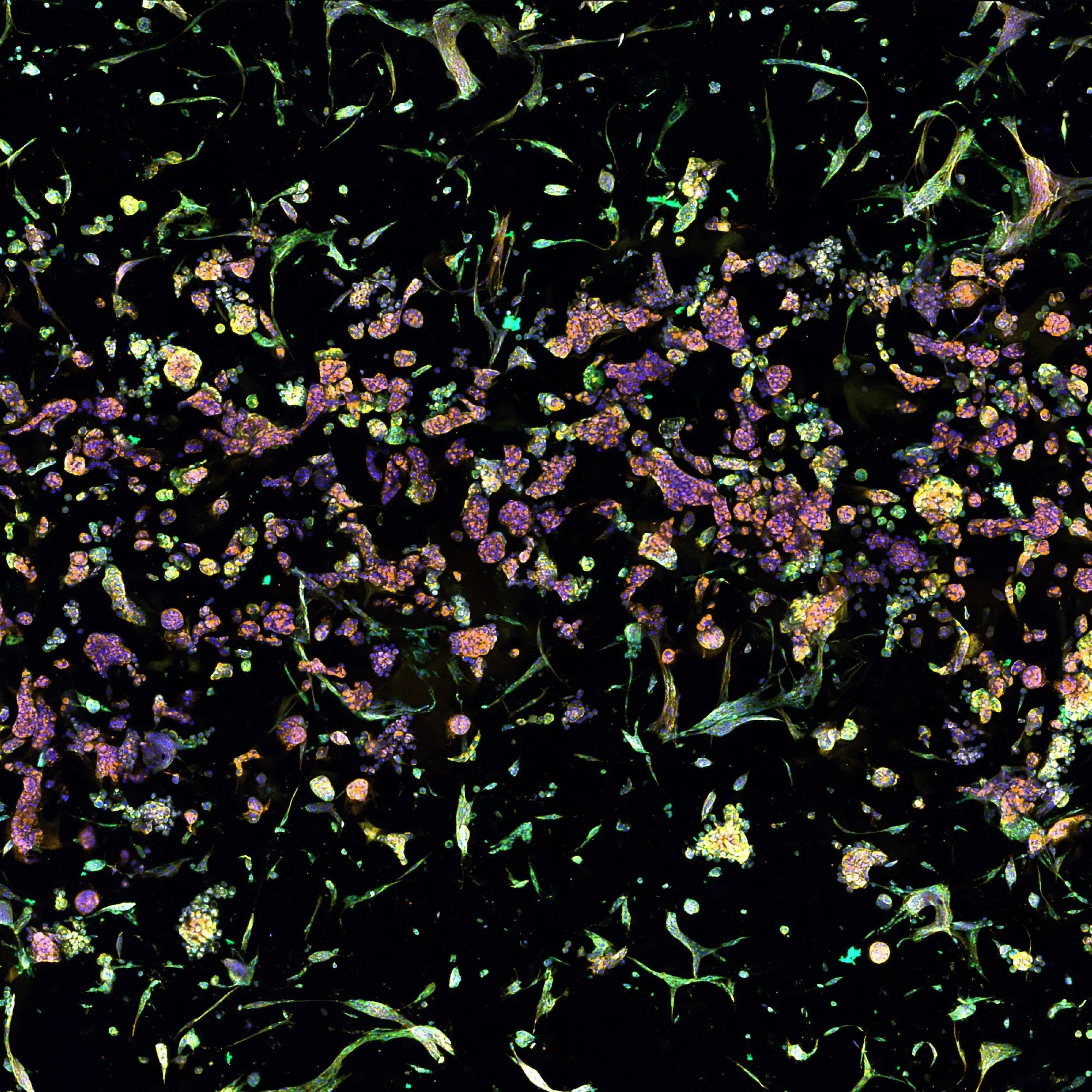 Tumor-fibroblast cell interactions within RASTRUM’s Triple Matrix Model architecture